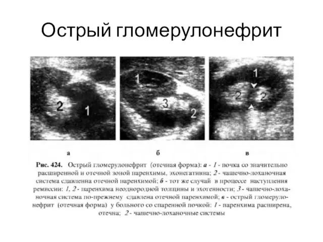 Острый гломерулонефрит