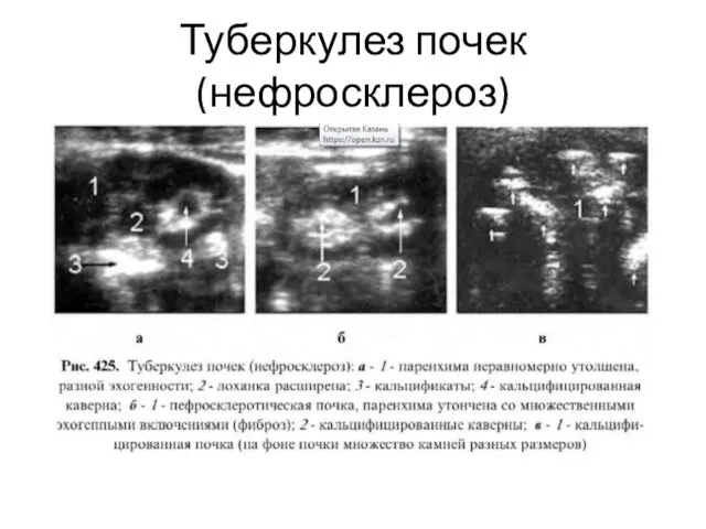 Туберкулез почек (нефросклероз)