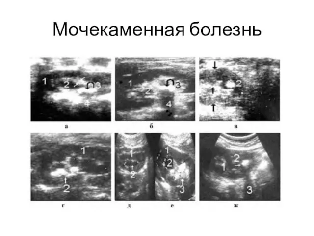 Мочекаменная болезнь