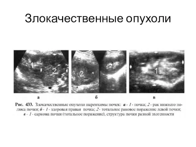 Злокачественные опухоли