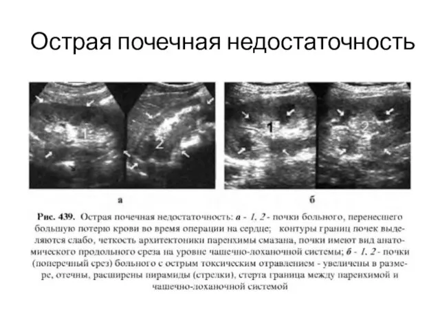 Острая почечная недостаточность