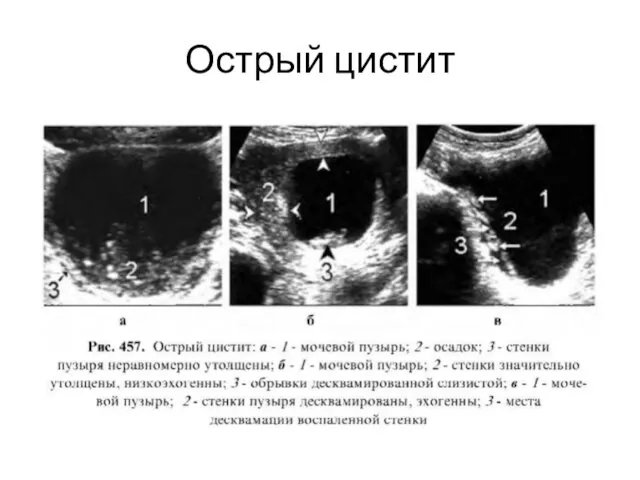 Острый цистит