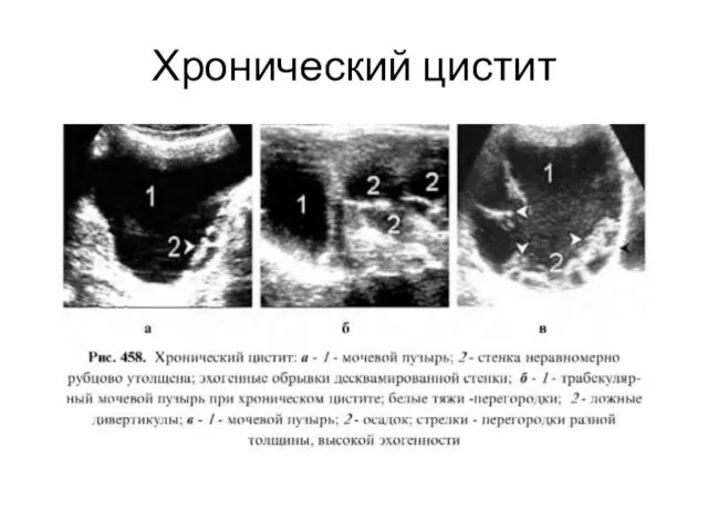 Хронический цистит