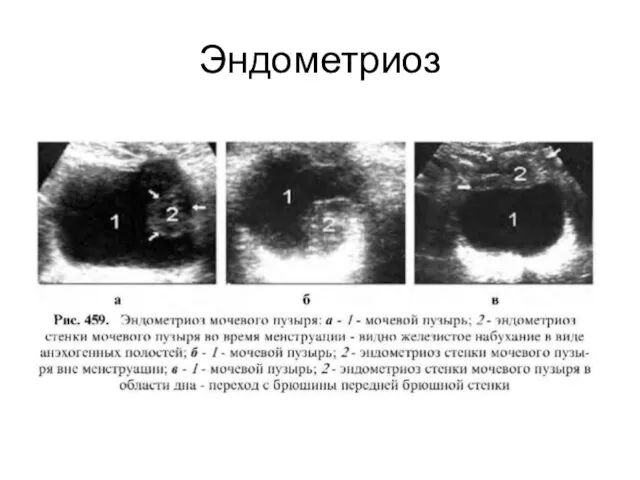 Эндометриоз