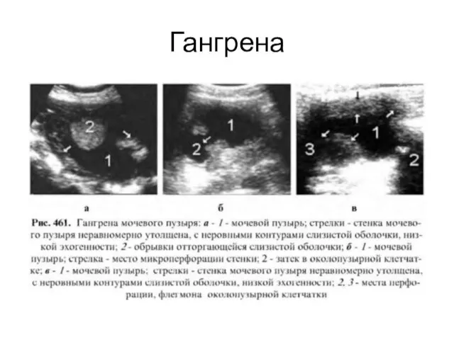 Гангрена