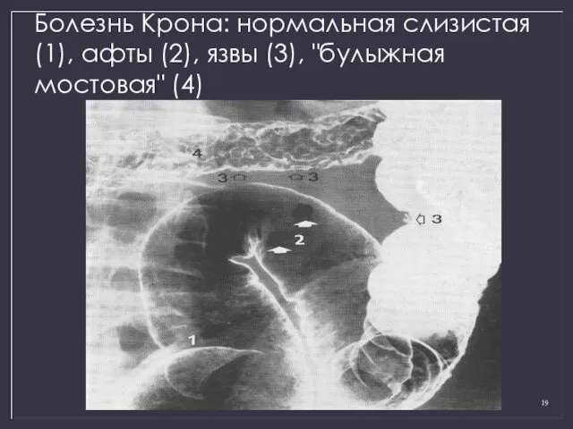 Болезнь Крона: нормальная слизистая (1), афты (2), язвы (3), "булыжная мостовая" (4)