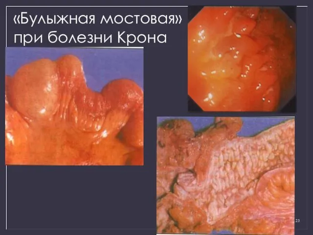 «Булыжная мостовая» при болезни Крона