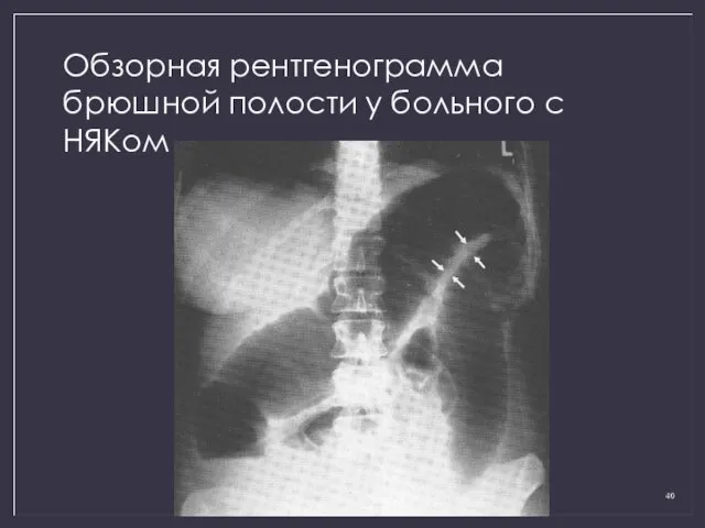 Обзорная рентгенограмма брюшной полости у больного с НЯКом