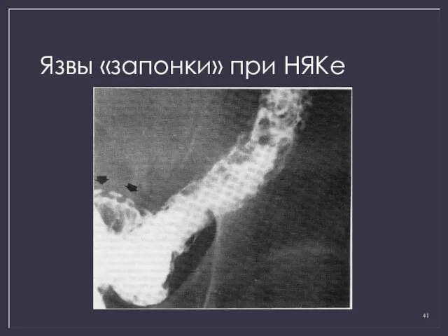 Язвы «запонки» при НЯКе