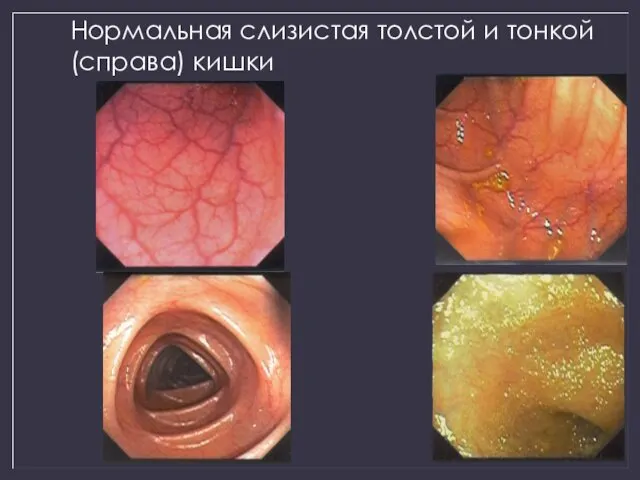 Нормальная слизистая толстой и тонкой (справа) кишки