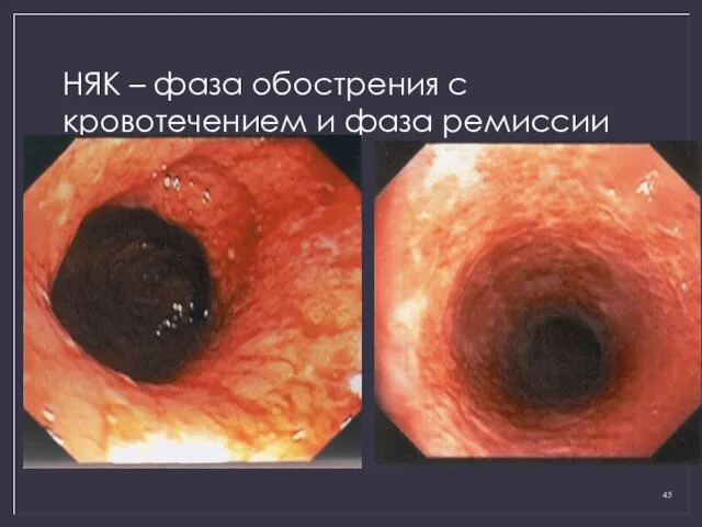 НЯК – фаза обострения с кровотечением и фаза ремиссии
