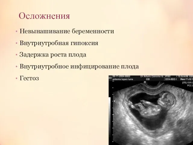Осложнения Невынашивание беременности Внутриутробная гипоксия Задержка роста плода Внутриутробное инфицирование плода Гестоз