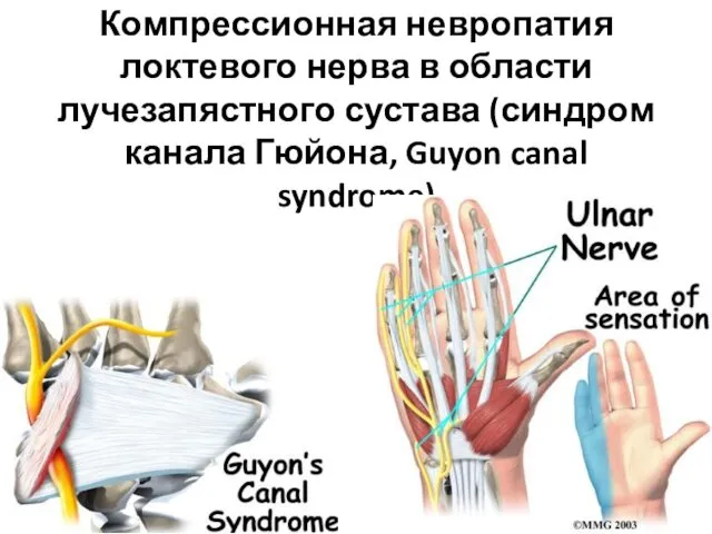 Компрессионная невропатия локтевого нерва в области лучезапястного сустава (синдром канала Гюйона, Guyon canal syndrome)