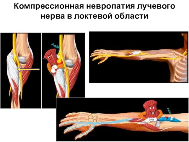 Компрессионная невропатия лучевого нерва в локтевой области
