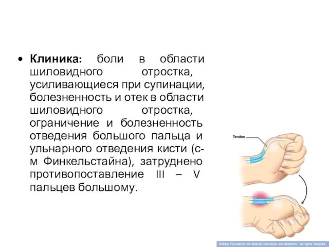 Клиника: боли в области шиловидного отростка, усиливающиеся при супинации, болезненность и отек в