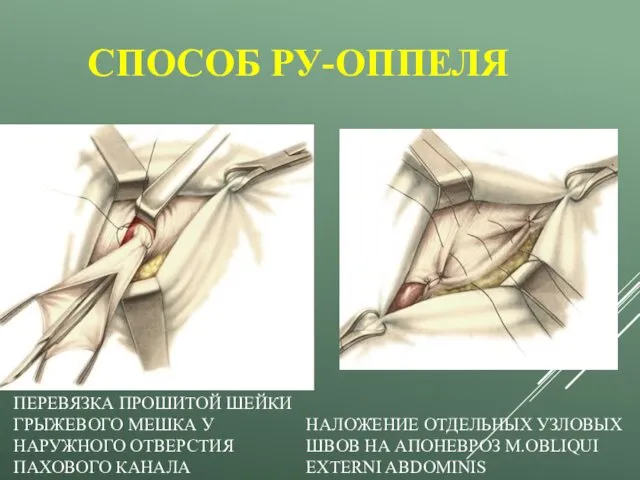 СПОСОБ РУ-ОППЕЛЯ ПЕРЕВЯЗКА ПРОШИТОЙ ШЕЙКИ ГРЫЖЕВОГО МЕШКА У НАРУЖНОГО ОТВЕРСТИЯ ПАХОВОГО КАНАЛА НАЛОЖЕНИЕ