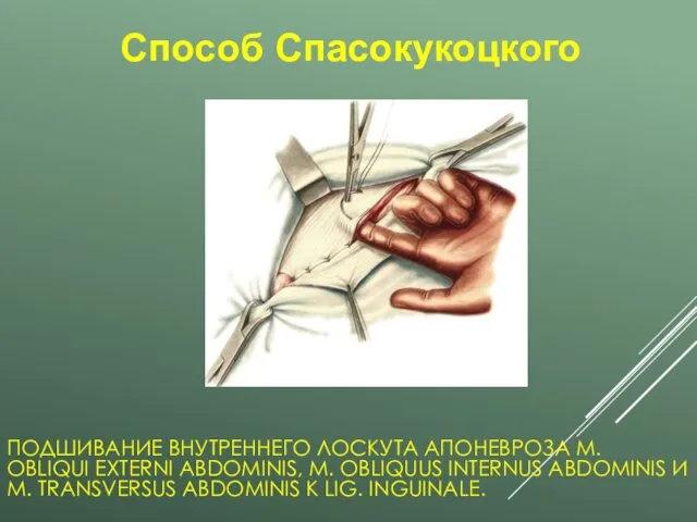 ПОДШИВАНИЕ ВНУТРЕННЕГО ЛОСКУТА АПОНЕВРОЗА M. OBLIQUI EXTERNI ABDOMINIS, M. OBLIQUUS INTERNUS ABDOMINIS И