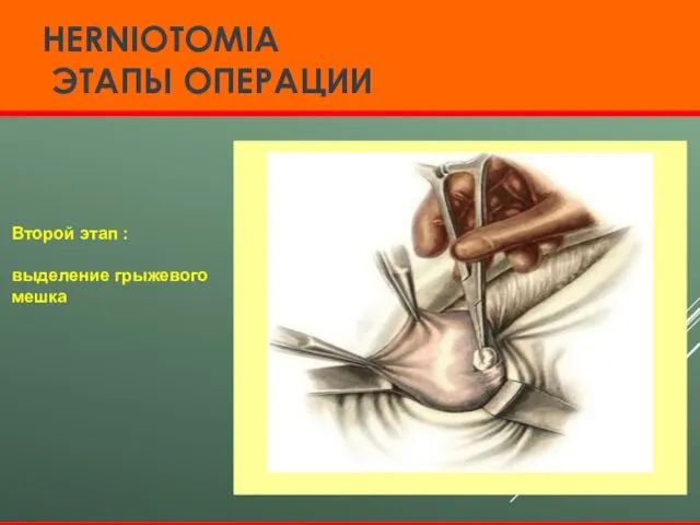 HERNIOTOMIA ЭТАПЫ ОПЕРАЦИИ Второй этап : выделение грыжевого мешка