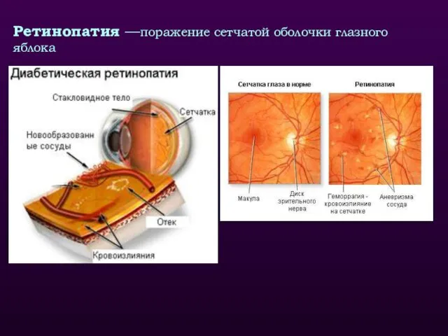 Ретинопатия —поражение сетчатой оболочки глазного яблока