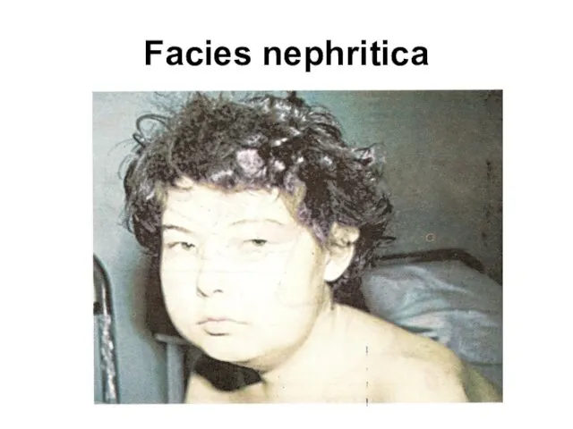 Facies nephritica