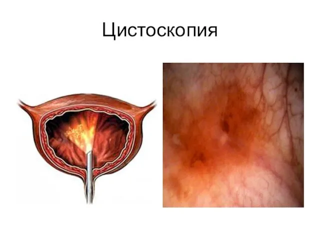 Цистоскопия