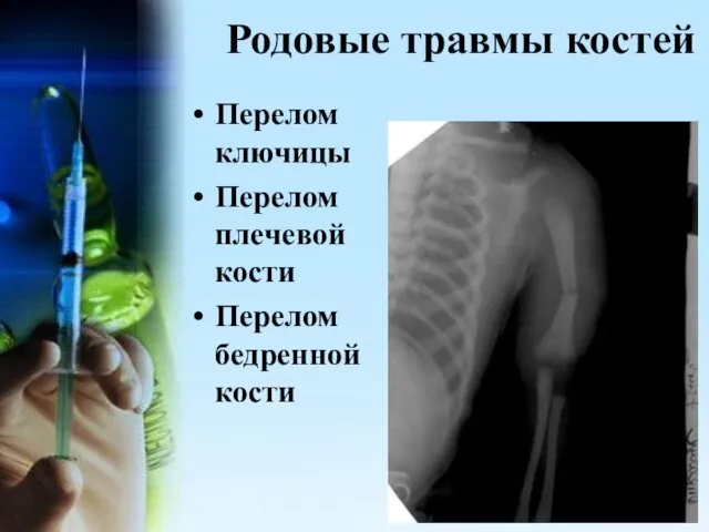Родовые травмы костей Перелом ключицы Перелом плечевой кости Перелом бедренной кости