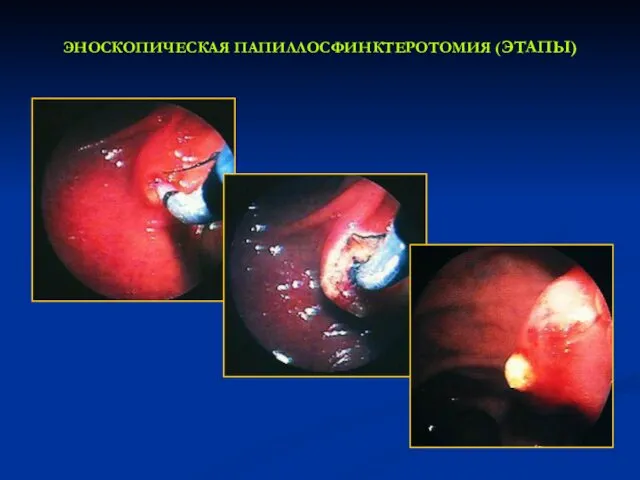 ЭНОСКОПИЧЕСКАЯ ПАПИЛЛОСФИНКТЕРОТОМИЯ (ЭТАПЫ)