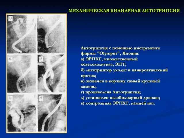 МЕХАНИЧЕСКАЯ БИЛИАРНАЯ ЛИТОТРИПСИЯ Литотрипсия с помощью инструмента фирмы "Olympus", Япония: