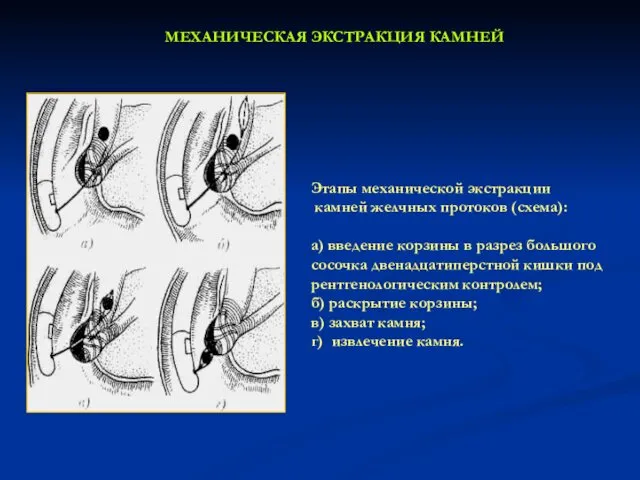 МЕХАНИЧЕСКАЯ ЭКСТРАКЦИЯ КАМНЕЙ Этапы механической экстракции камней желчных протоков (схема): а) введение корзины