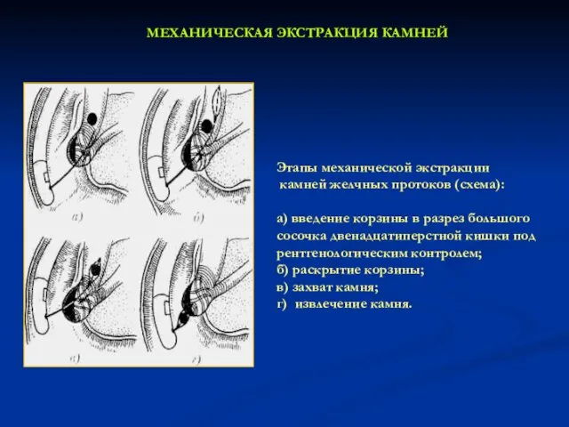 МЕХАНИЧЕСКАЯ ЭКСТРАКЦИЯ КАМНЕЙ Этапы механической экстракции камней желчных протоков (схема):