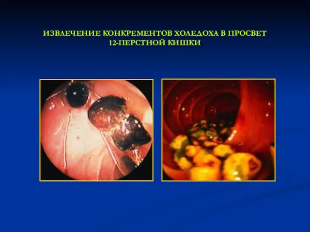 ИЗВЛЕЧЕНИЕ КОНКРЕМЕНТОВ ХОЛЕДОХА В ПРОСВЕТ 12-ПЕРСТНОЙ КИШКИ