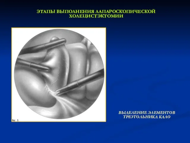 ЭТАПЫ ВЫПОЛНЕНИЯ ЛАПАРОСКОПИЧЕСКОЙ ХОЛЕЦИСТЭКТОМИИ ВЫДЕЛЕНИЕ ЭЛЕМЕНТОВ ТРЕУГОЛЬНИКА КАЛО