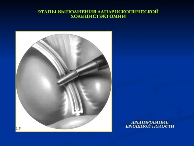 ЭТАПЫ ВЫПОЛНЕНИЯ ЛАПАРОСКОПИЧЕСКОЙ ХОЛЕЦИСТЭКТОМИИ ДРЕНИРОВАНИЕ БРЮШНОЙ ПОЛОСТИ