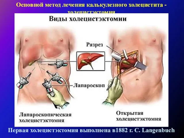 Основной метод лечения калькулезного холецистита -холецистэктомия Первая холецистэктомия выполнена в1882 г. C. Langenbuch