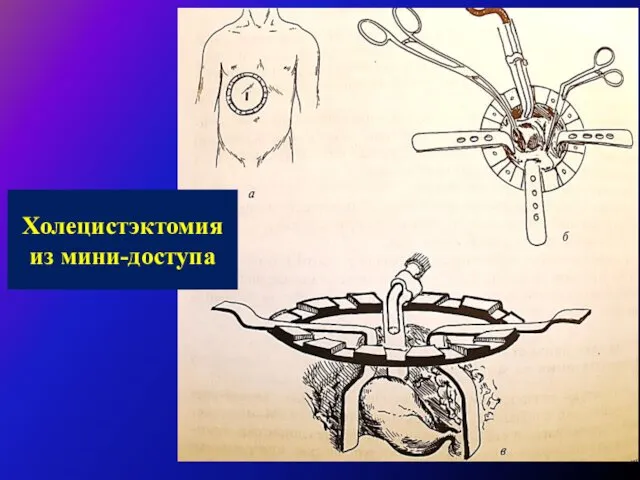 Холецистэктомия из мини-доступа