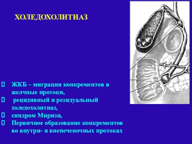 ЖКБ – миграция конкрементов в желчные протоки, рецидивный и резидуальный холедохолитиаз, синдром Миризи,