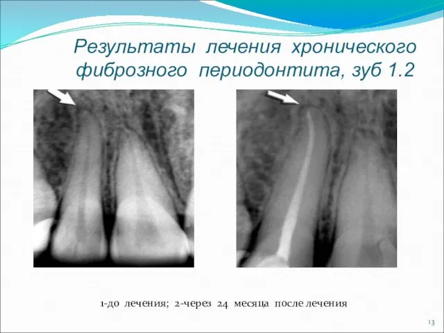 Результаты лечения хронического фиброзного периодонтита, зуб 1.2 1-до лечения; 2-через 24 месяца после лечения