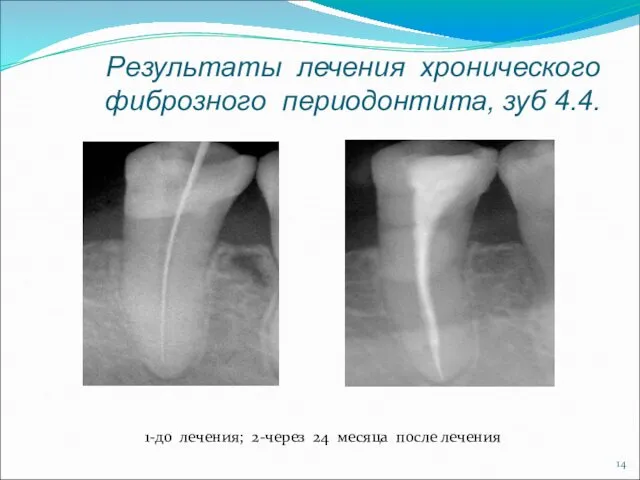 Результаты лечения хронического фиброзного периодонтита, зуб 4.4. 1-до лечения; 2-через 24 месяца после лечения