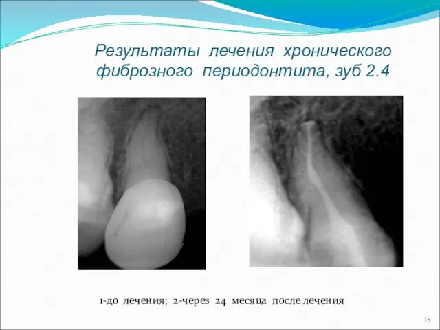 Результаты лечения хронического фиброзного периодонтита, зуб 2.4 1-до лечения; 2-через 24 месяца после лечения