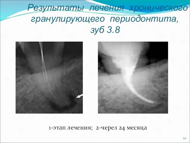 Результаты лечения хронического гранулирующего периодонтита, зуб 3.8 1-этап лечения; 2-через 24 месяца