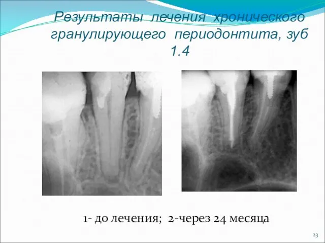 Результаты лечения хронического гранулирующего периодонтита, зуб 1.4 1- до лечения; 2-через 24 месяца