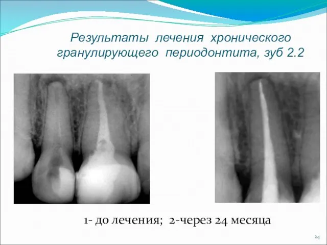Результаты лечения хронического гранулирующего периодонтита, зуб 2.2 1- до лечения; 2-через 24 месяца