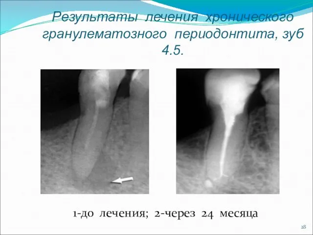 Результаты лечения хронического гранулематозного периодонтита, зуб 4.5. 1-до лечения; 2-через 24 месяца