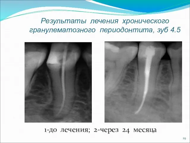 Результаты лечения хронического гранулематозного периодонтита, зуб 4.5 1-до лечения; 2-через 24 месяца