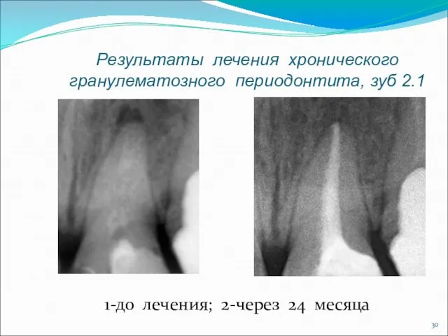 Результаты лечения хронического гранулематозного периодонтита, зуб 2.1 1-до лечения; 2-через 24 месяца