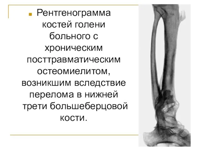 Рентгенограмма костей голени больного с хроническим посттравматическим остеомиелитом, возникшим вследствие перелома в нижней трети большеберцовой кости.