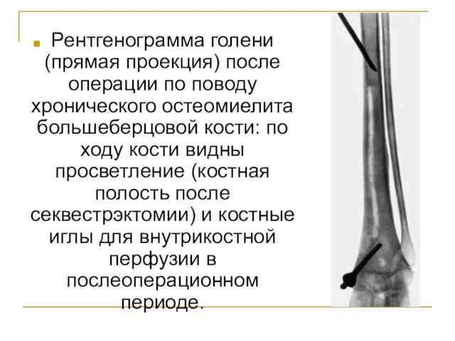 Рентгенограмма голени (прямая проекция) после операции по поводу хронического остеомиелита