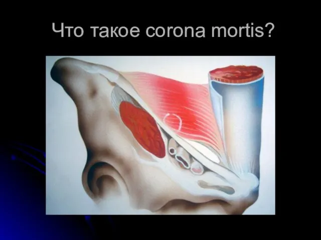Что такое corona mortis?