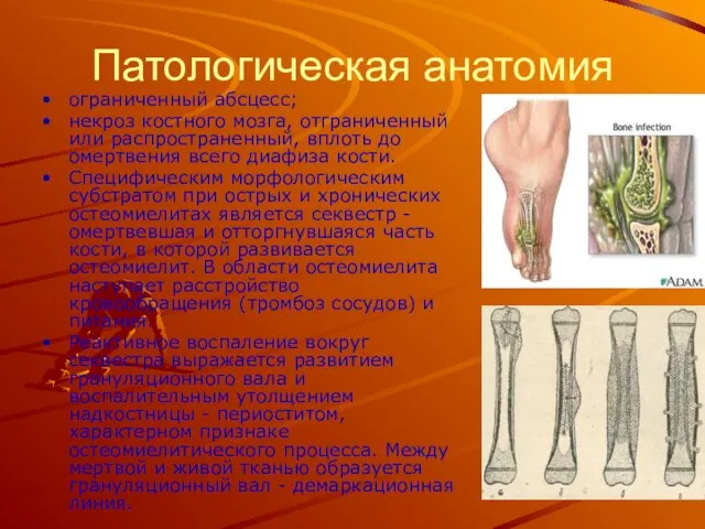 Патологическая анатомия ограниченный абсцесс; некроз костного мозга, отграниченный или распространенный, вплоть до омертвения