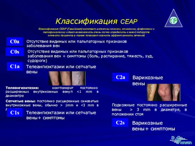 Классификация CEAP Классификация CEAP (Гавайскаяi) включает аспектиы клиники, этиологии, фнфтомии